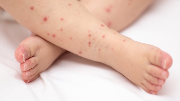 【医師が警鐘】乳幼児期のアトピー放置は危険！生涯リスクを下げる早期ケアとは