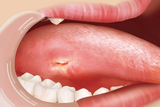 ［図表4］舌がんになった口中①