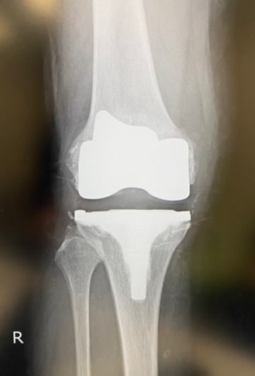 すり減った軟骨、傷んだ骨、半月板を切除して金属やプラスチックでできた人工の関節に置き換える