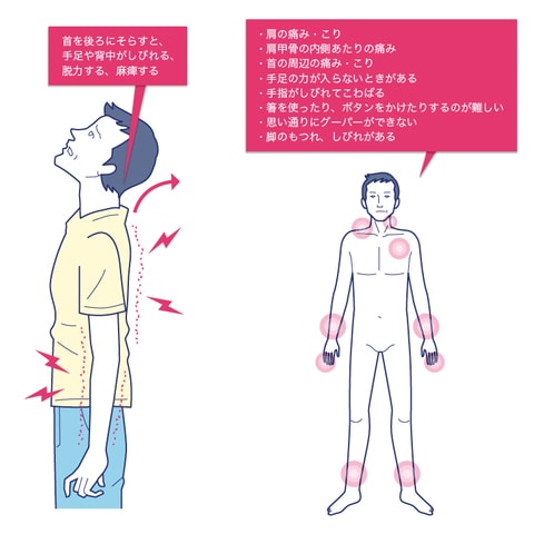 ［図表2］「頚椎症」の初期症状例