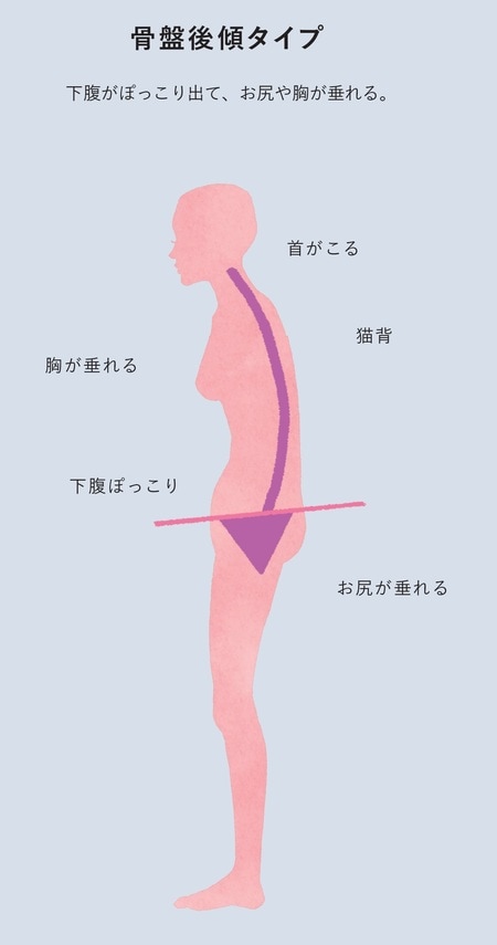 骨盤後傾タイプ