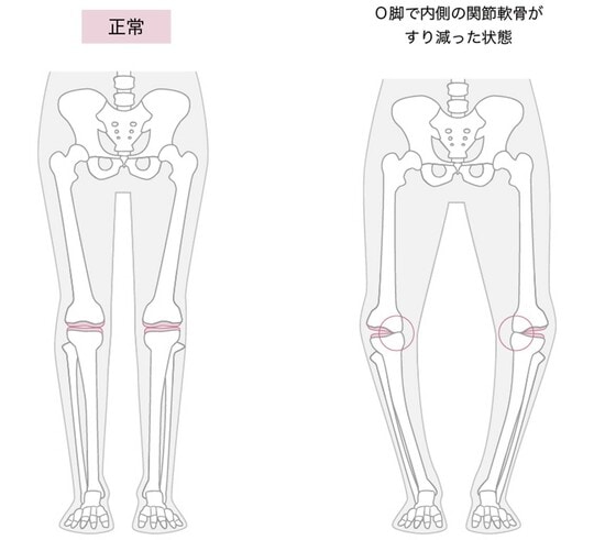 ［図表2］正常な脚と、O客で内側の関節軟骨がすり減った状態