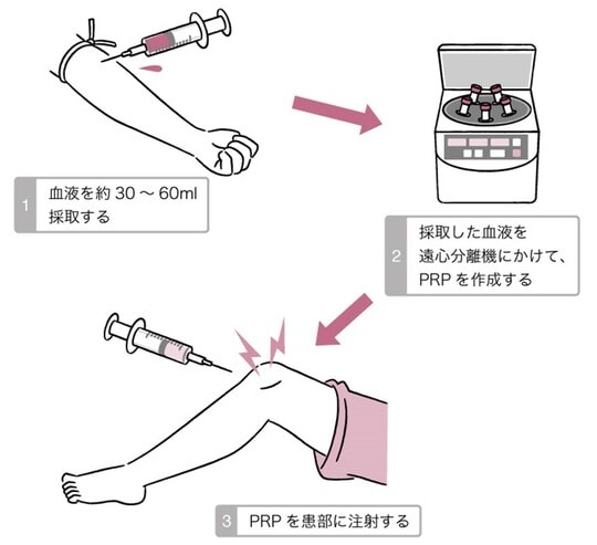 ［図表2］一般的なPRP治療の流れ