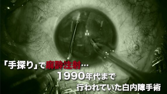 「手探り」で麻酔注射…1990年代まで行われていた白内障手術