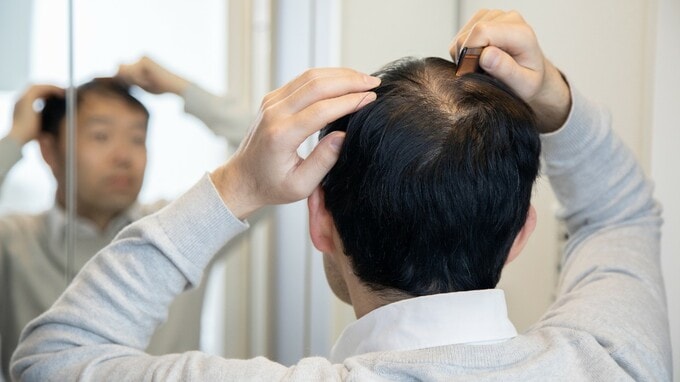 ほとんどの人が勘違いしている…「薄毛」と「抜け毛」の意外な関係【専門医が解説】