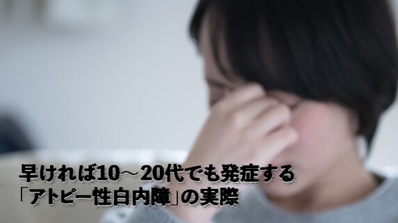 早ければ10〜20代でも発症する「アトピー性白内障」の実際