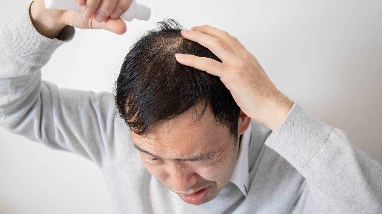 えっ、ハゲた?いつの間にか進行する薄毛…月5,000円の治療で「フサフサに戻る人」と「戻らない人」の差【専門医が解説】 | 幻冬舎ゴールドオンライン