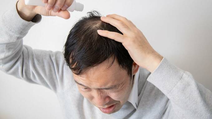 えっ、ハゲた？いつの間にか進行する薄毛…月5,000円の治療で「フサフサに戻る人」と「戻らない人」の差【専門医が解説】