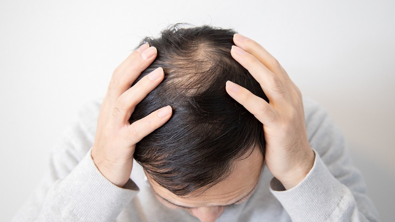 遺伝、年齢は関係ない…「薄毛は根本治療が可能」という事実