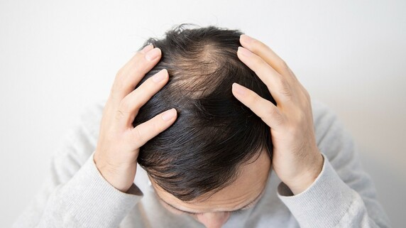 遺伝、年齢は関係ない…「薄毛は根本治療が可能」という事実