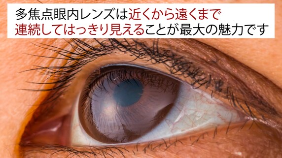 「多焦点眼内レンズの不適合」は、どんなときに起こるのか