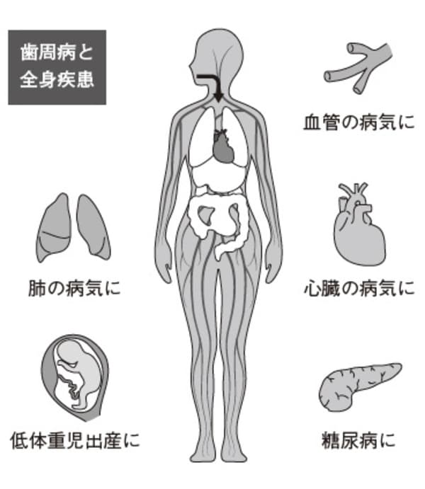 ［図表3］歯周病と全身疾患