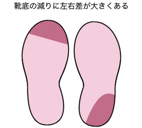 ［図表4］靴底の減りに左右差が大きくある